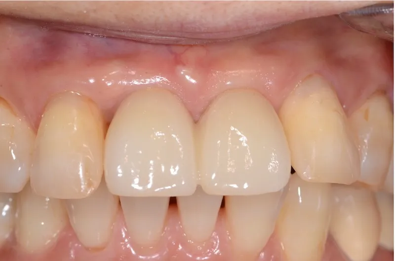 case1after