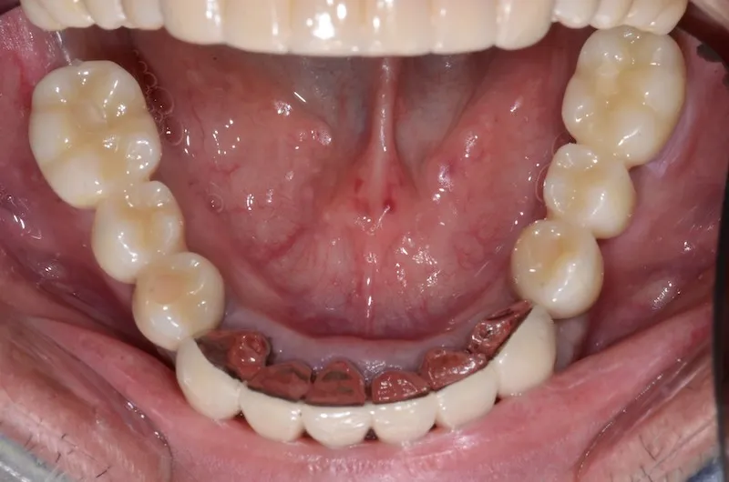 case2after