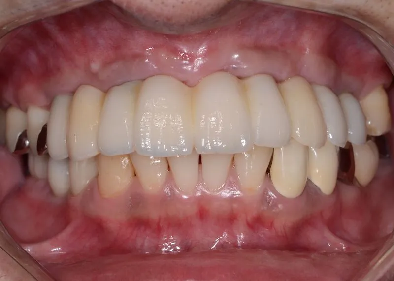 case4after