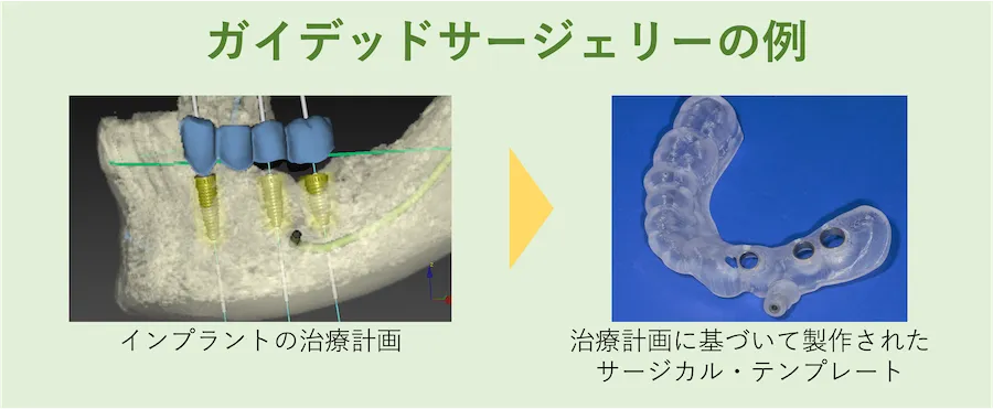 ガイデッドサージェリーの例